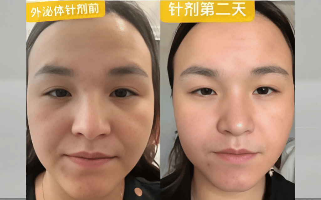 EXOSOMES FOR SKIN REJUVENATION - 5 BILLION PARTICAL