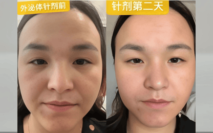 EXOSOMES FOR SKIN REJUVENATION - 5 BILLION PARTICAL - FOREVER - 25 - LIFESTYLES